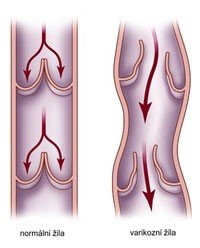 varikózní žíla